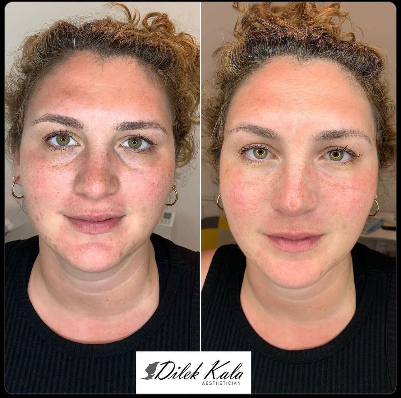 Dermapen Microneedling: How It Transforms Your Skin
