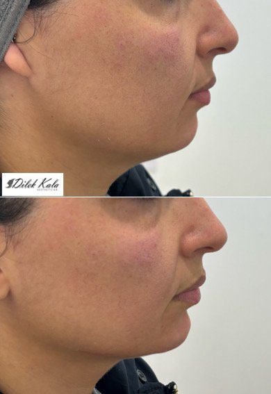 Treatment result 14