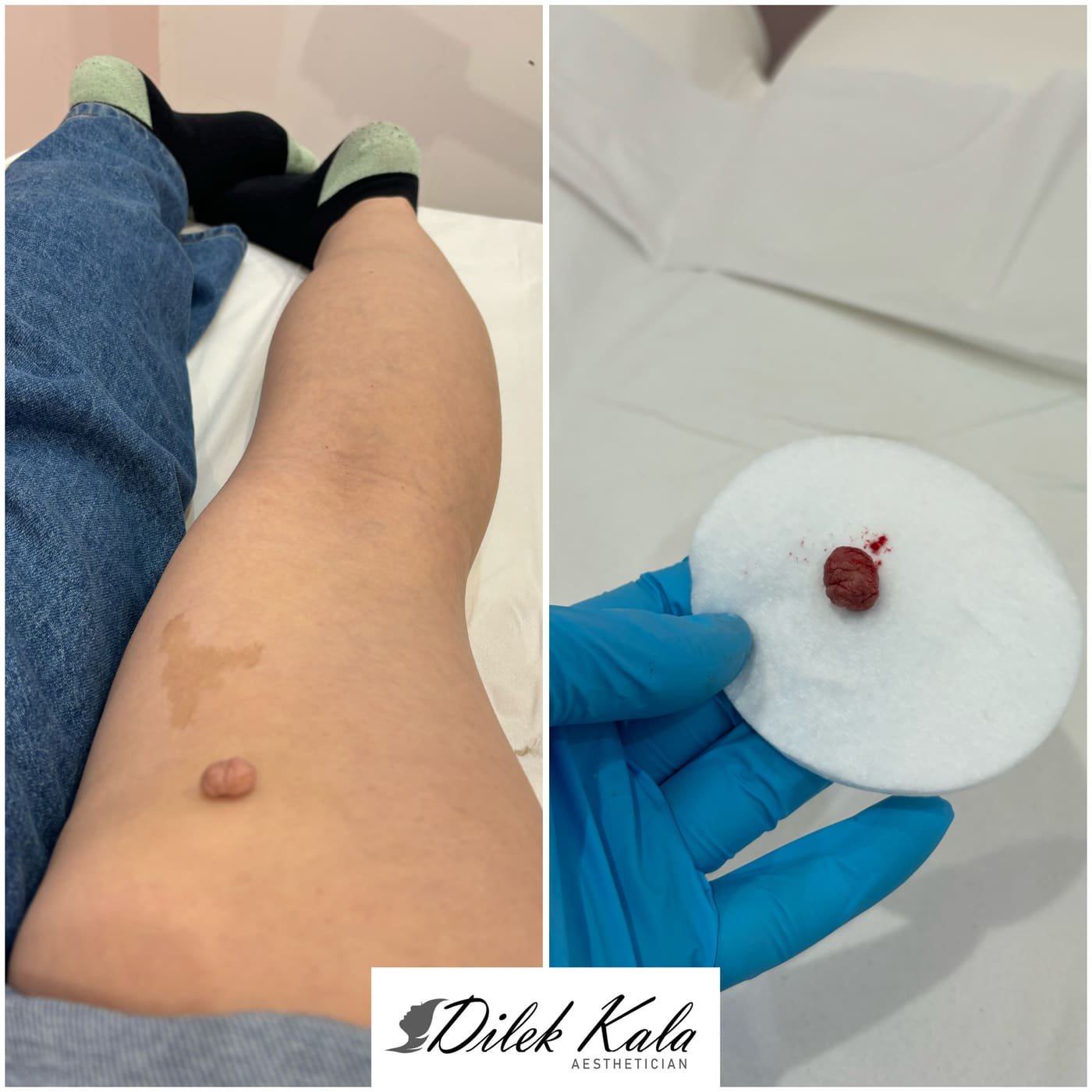 Treatment result 42