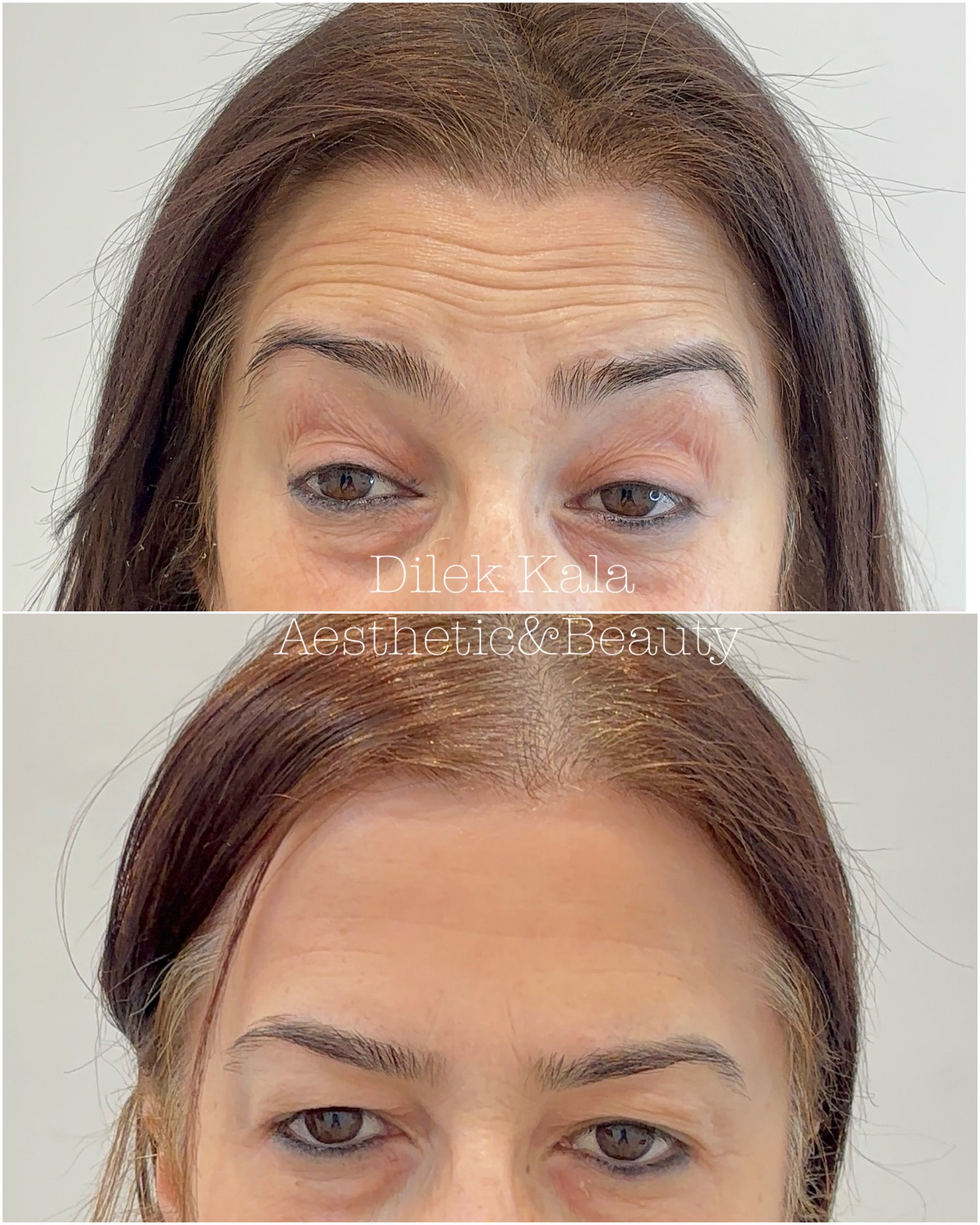 Anti-Wrinkle Treatment before and after result 2
