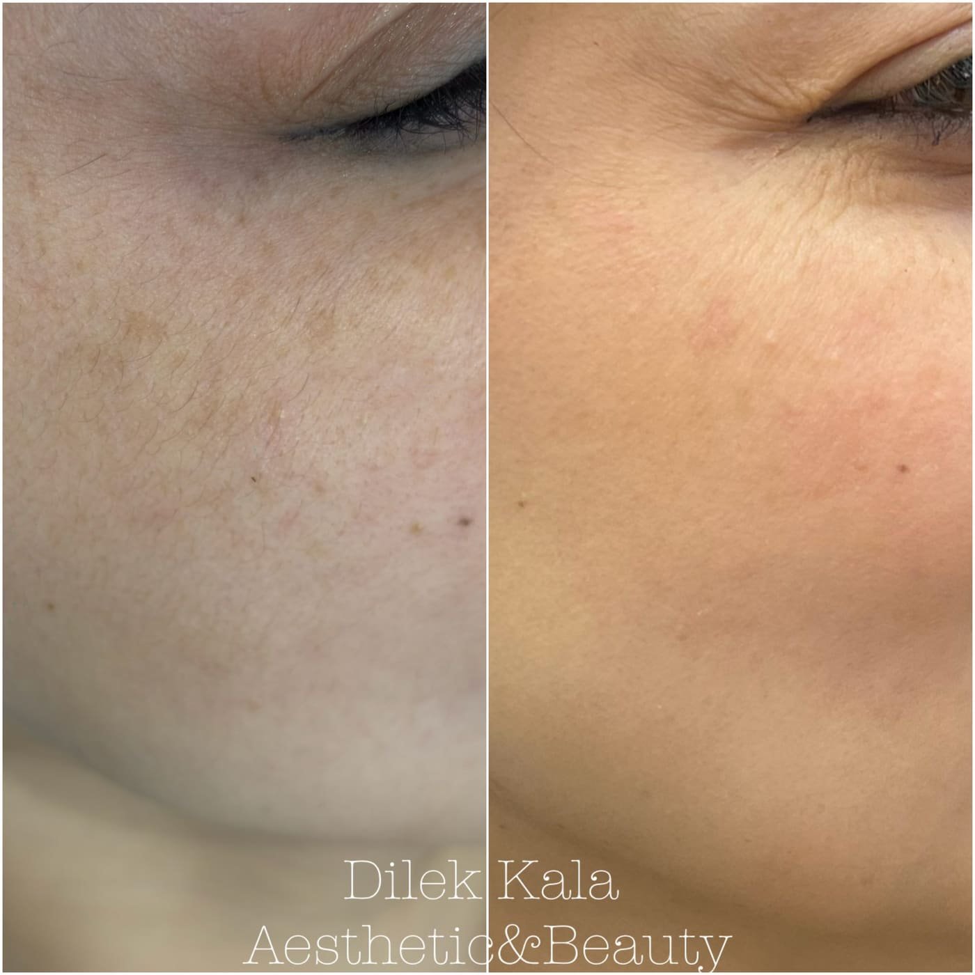Dermapen & Microneedling