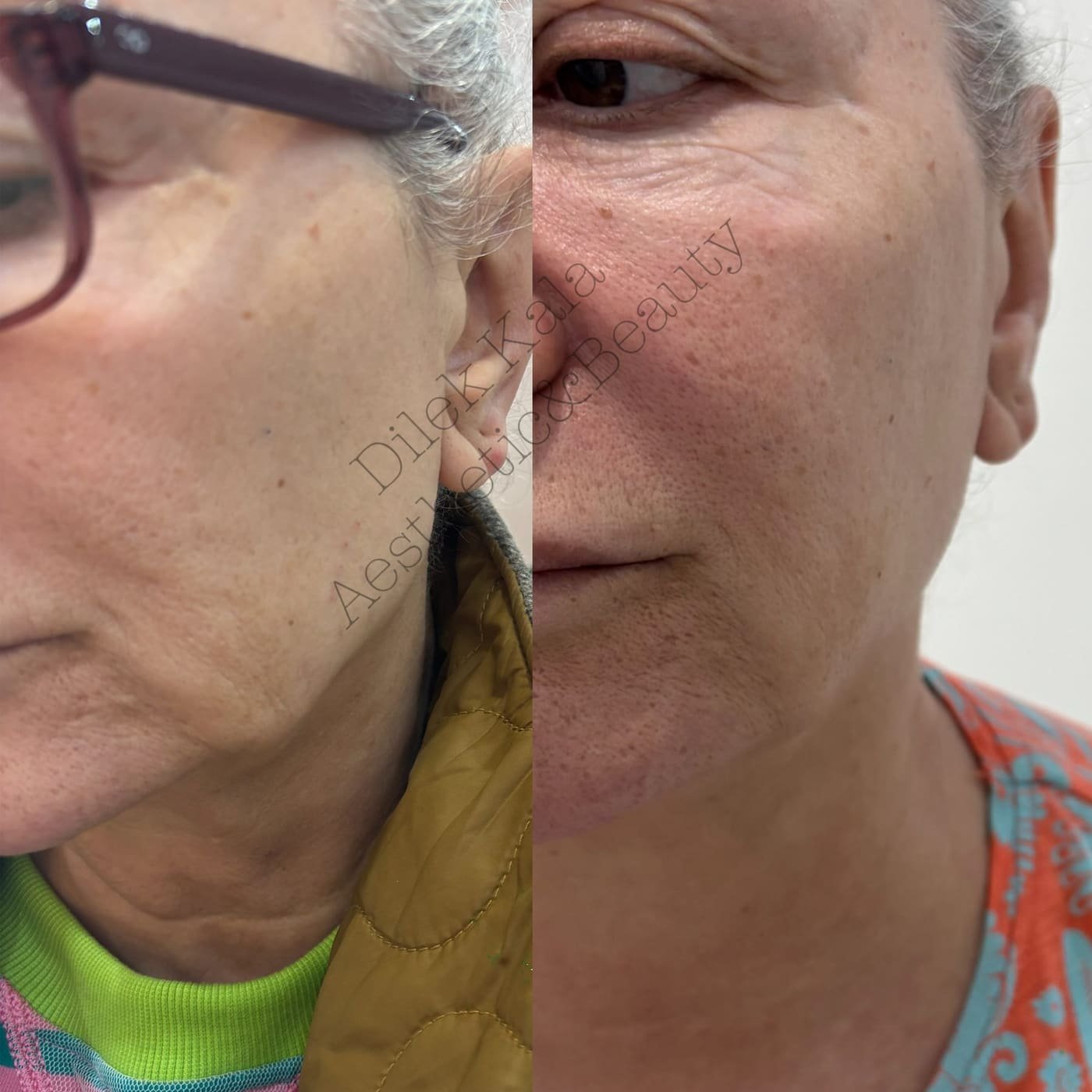 Facial Treatments before and after result 3