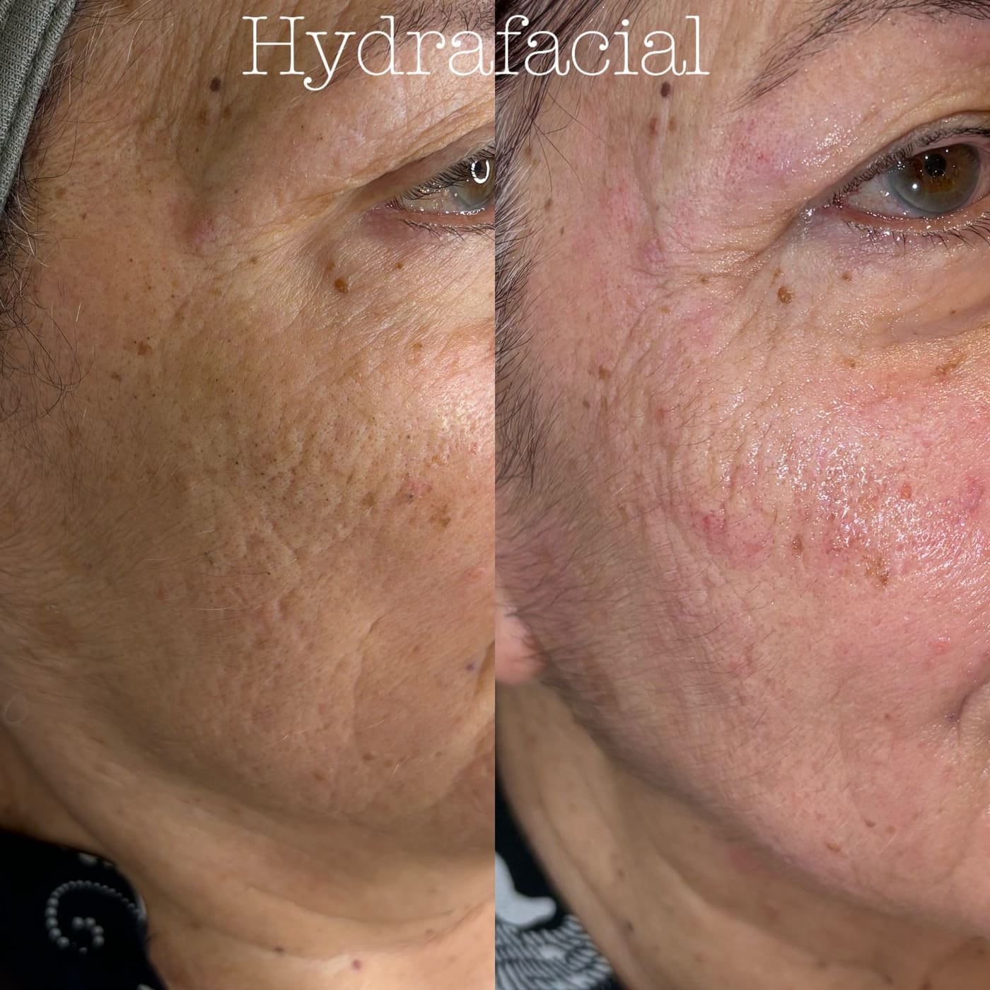 Facial Treatments