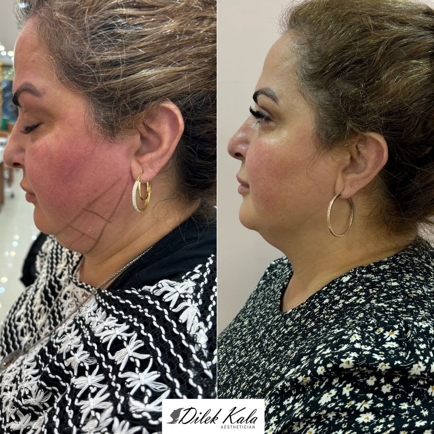 Fat Dissolving before and after result 1