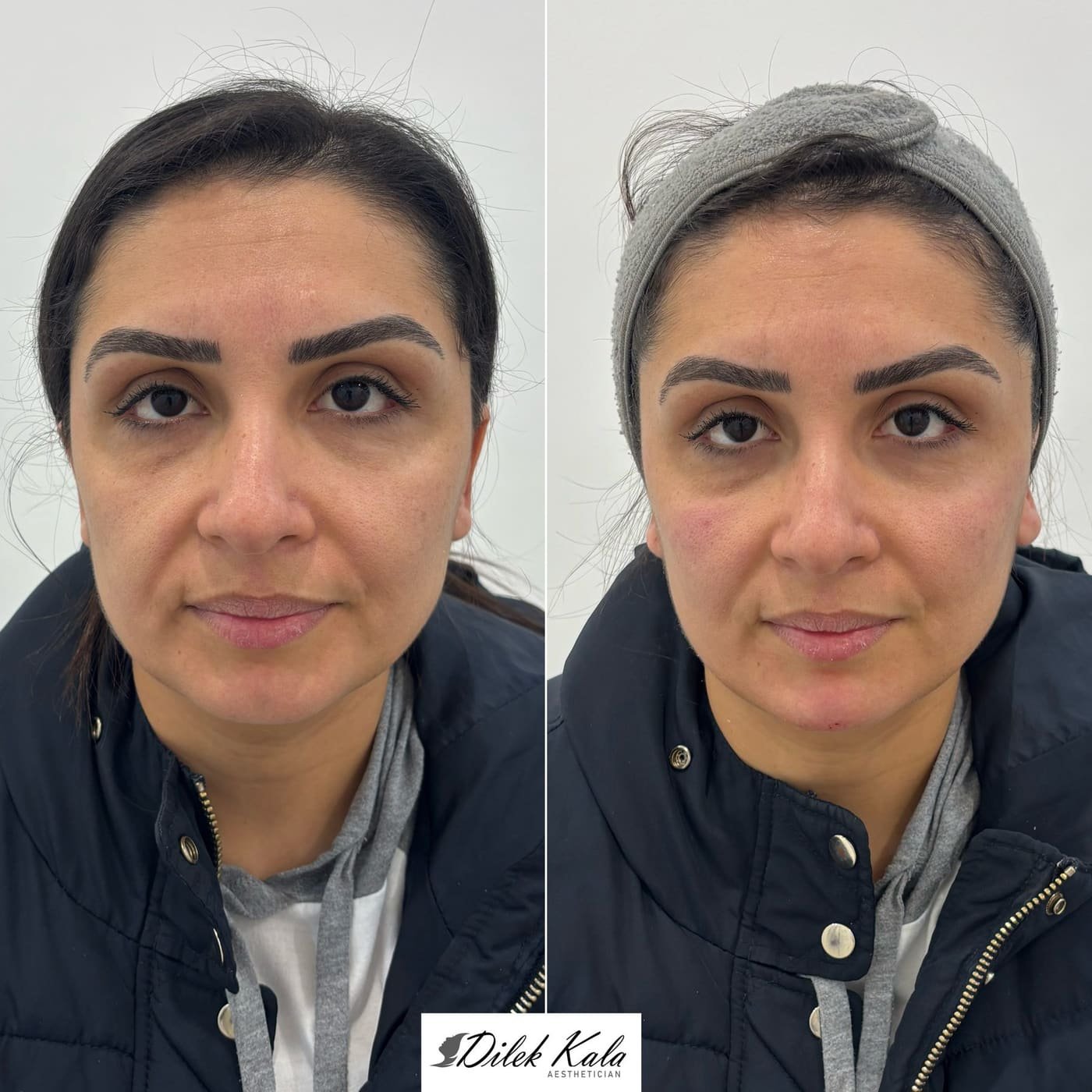 Jaw & Cheek Filler