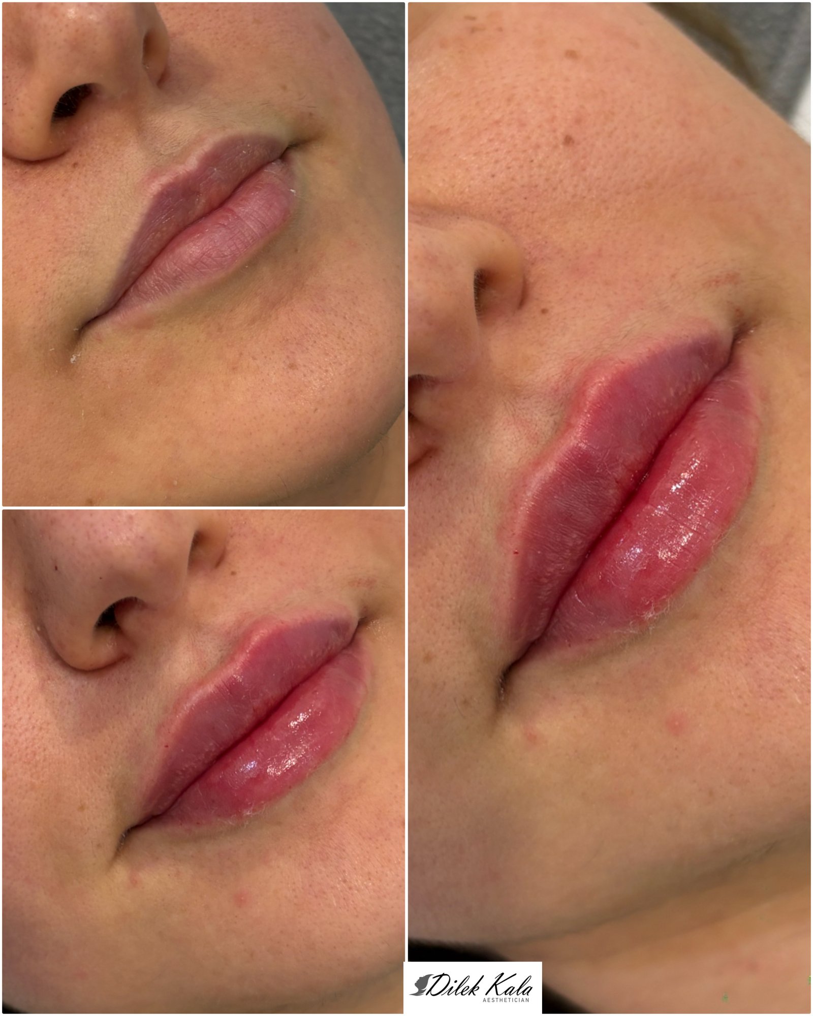 Lip Fillers before and after result 2