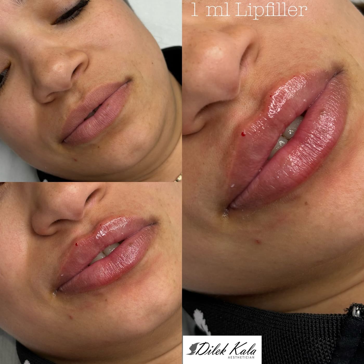 Lip Fillers before and after result 3