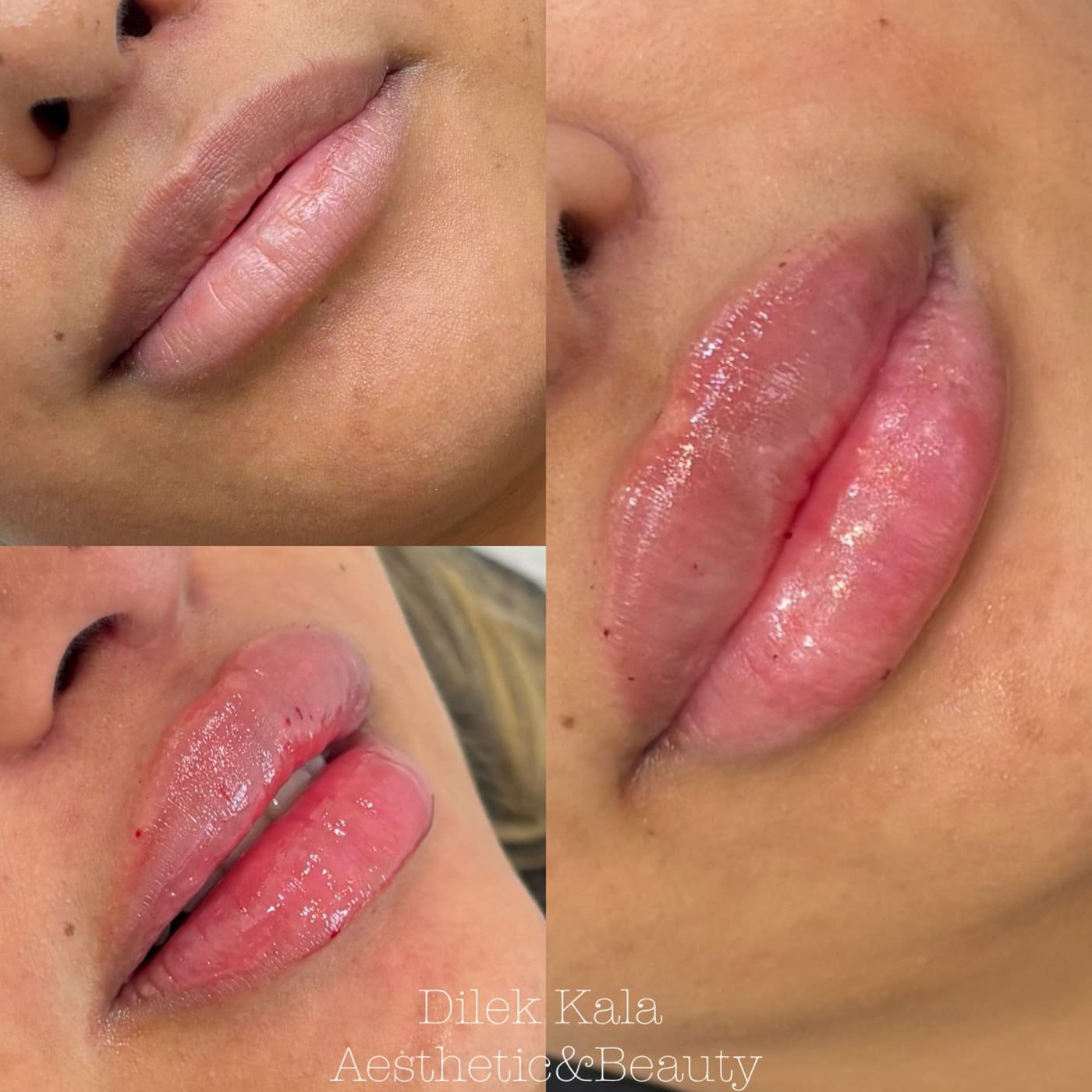Lip Fillers before and after result 5