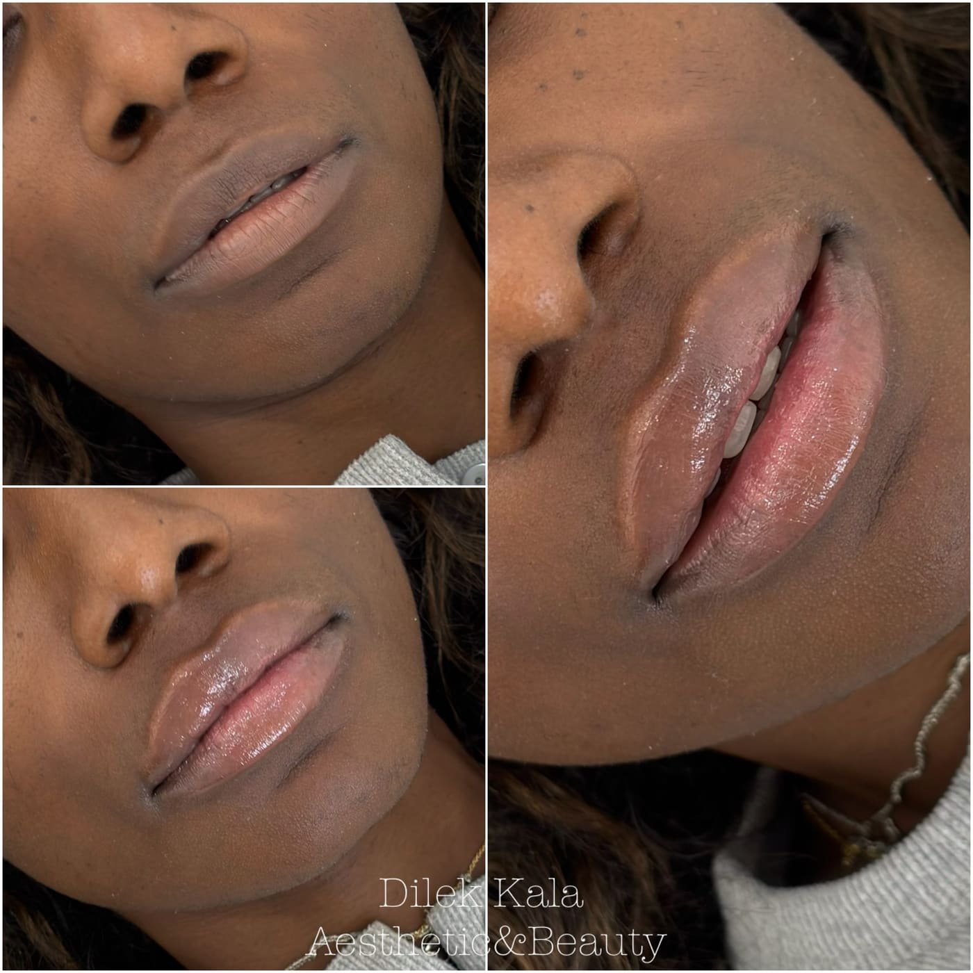 Lip Fillers before and after result 6
