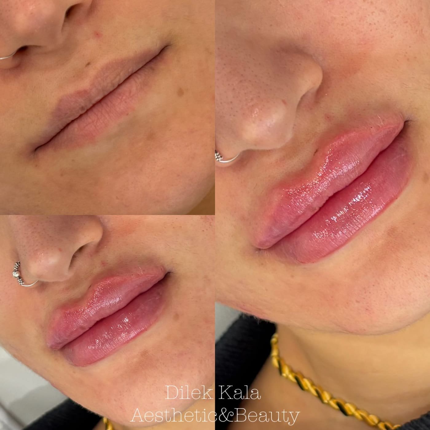Lip Fillers