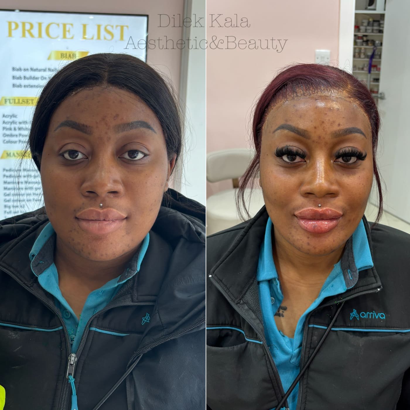 Skin Boosters
