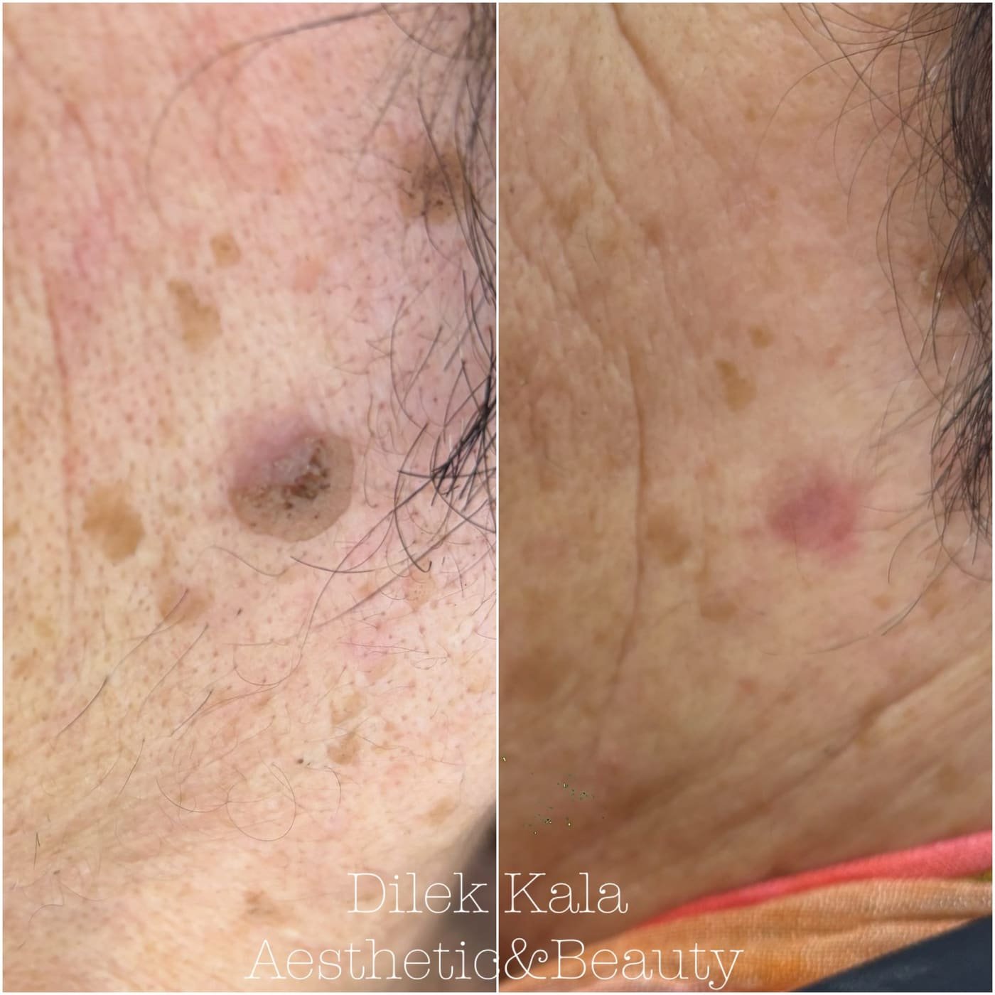 Skin Tag Removal before and after result 2