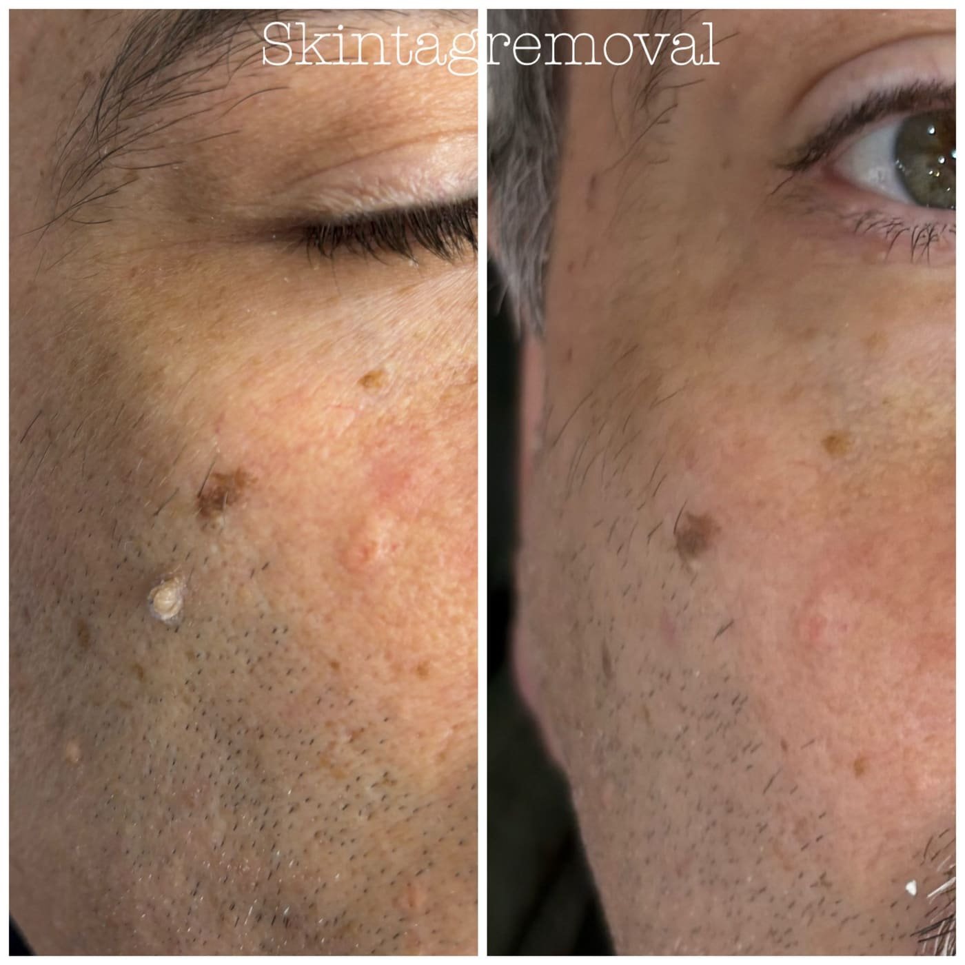 Skin Tag Removal