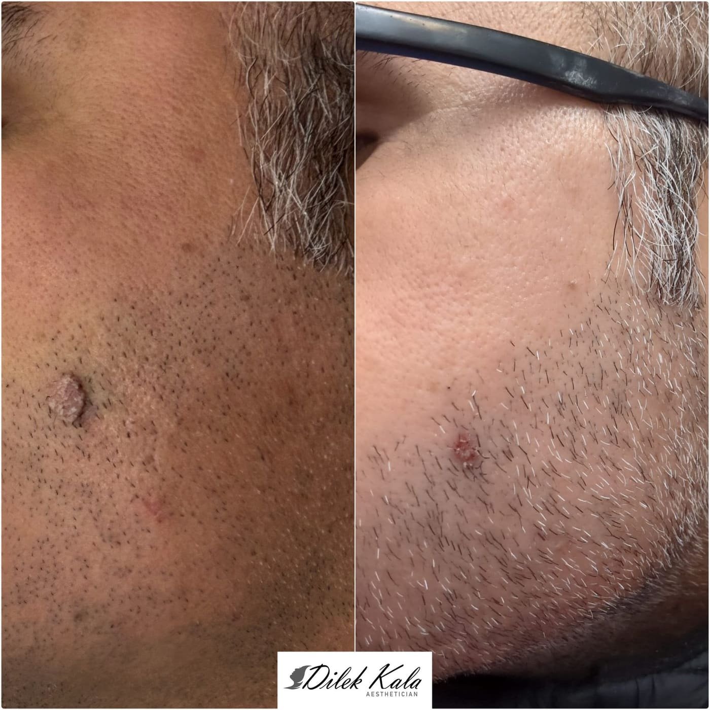 Skin Tag Removal before and after result 3