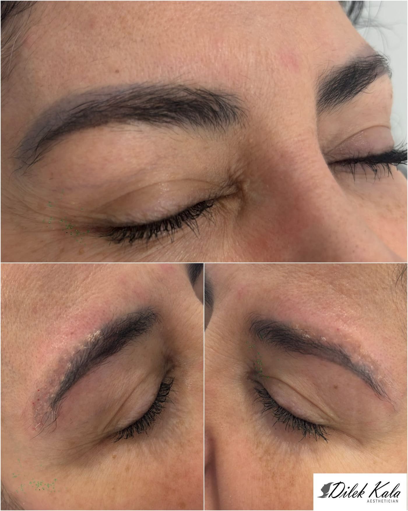Tattoo Removal before and after result 2